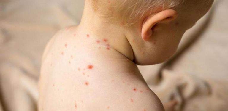 los niños enfermos de sarampion pueden padecer de pulmonia